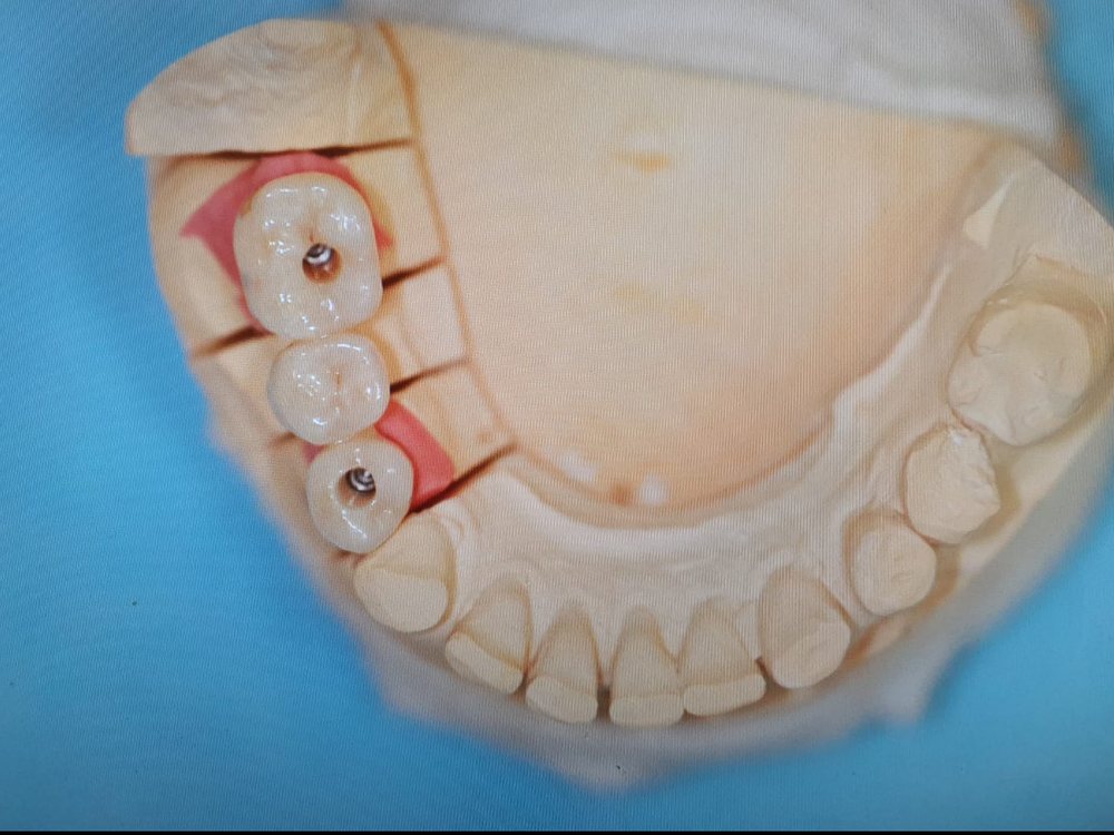 Dreigliedrige Implantatbrücke auf dem Arbeitsmodell