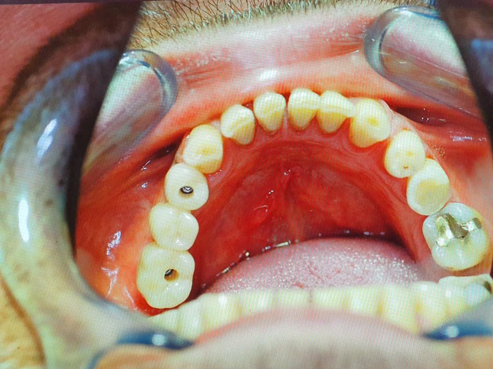 Festsitzende Brücke auf den Implantaten (Spiegelaufnahme)