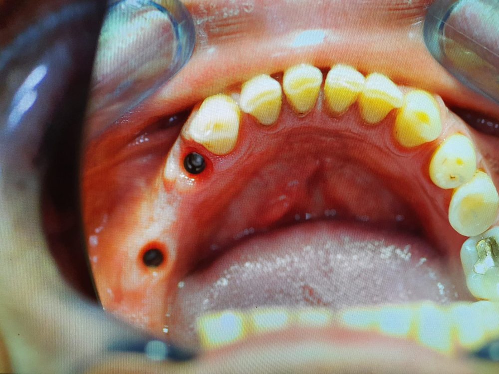 Zwei eingeheilte Implantate im Oberkiefer (Spiegelaufnahme)