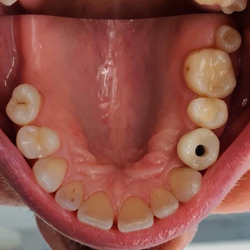 Implantatgetragene Krone an derselben Stelle (Spiegelaufnahme)