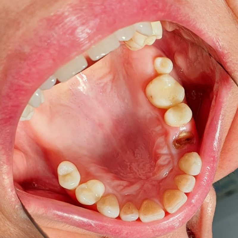 Zahnlücke im Oberkiefer mit eingeheiltem Implantat (Spiegelaufnahme)
